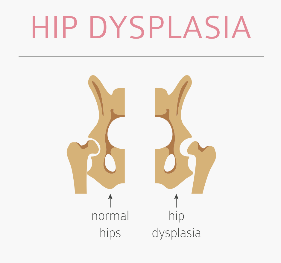 Why A totseat Is Ideal For A Child Wearing A Spica Cast with Hip Dysplasia