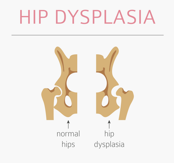 Why A totseat Is Ideal For A Child Wearing A Spica Cast with Hip Dysplasia